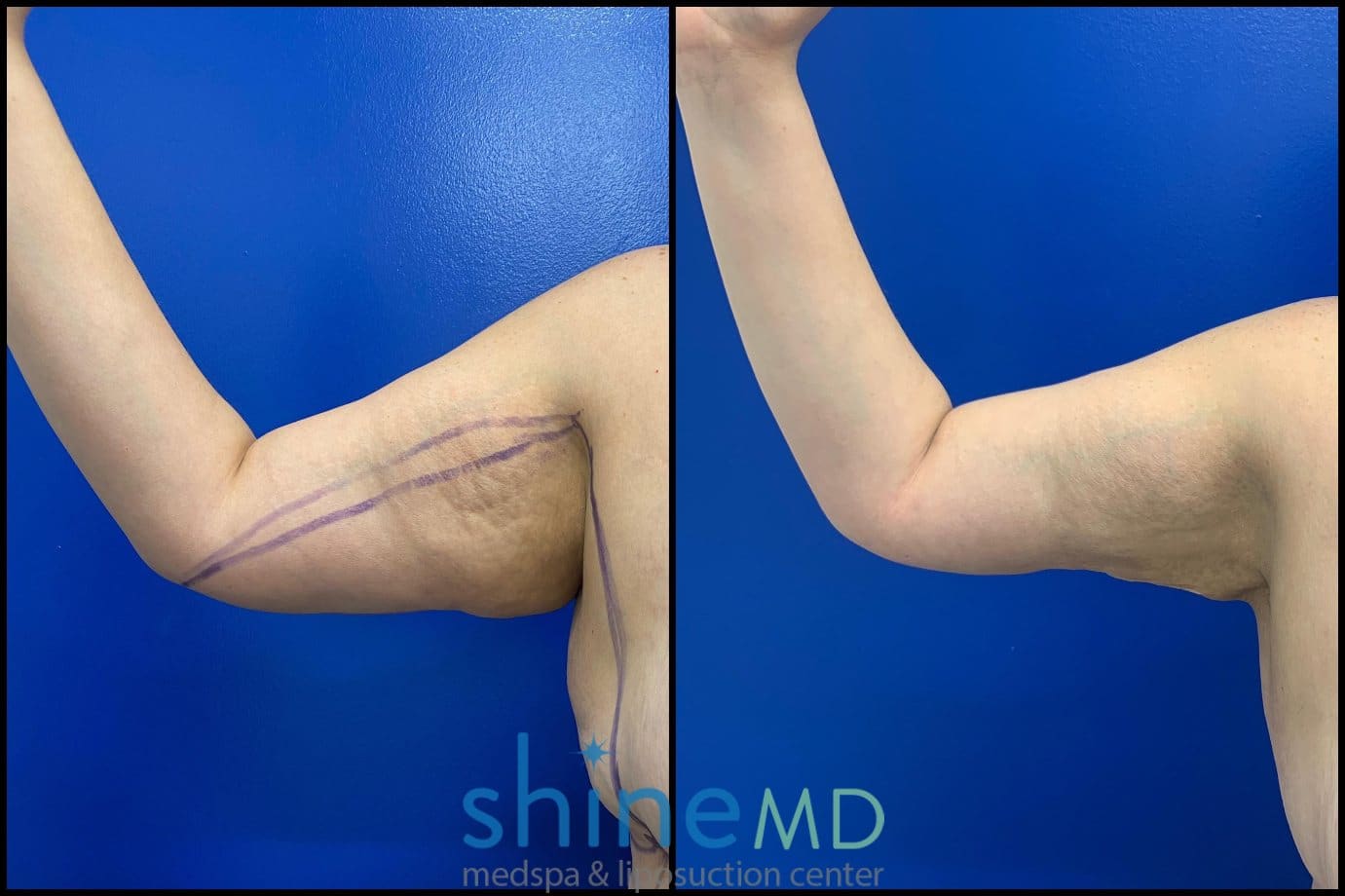 arm liposuction surgery results
