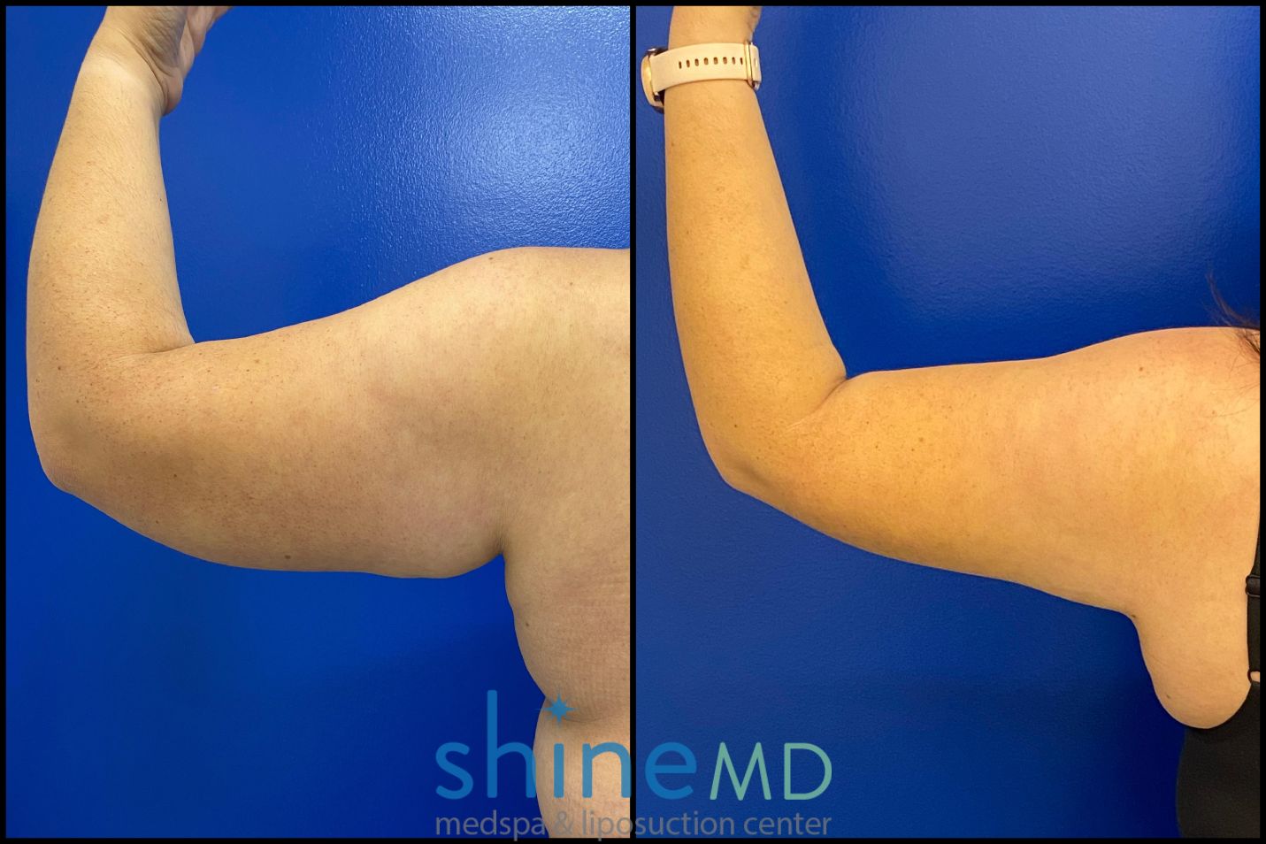 before and after photos of Back-Left-Arm-5