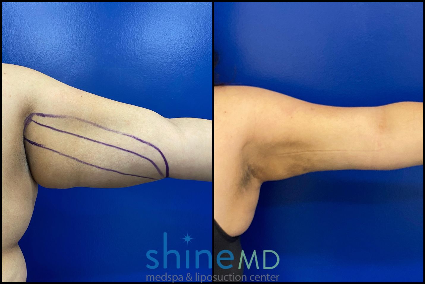 before and after photos of arm lipo surgery