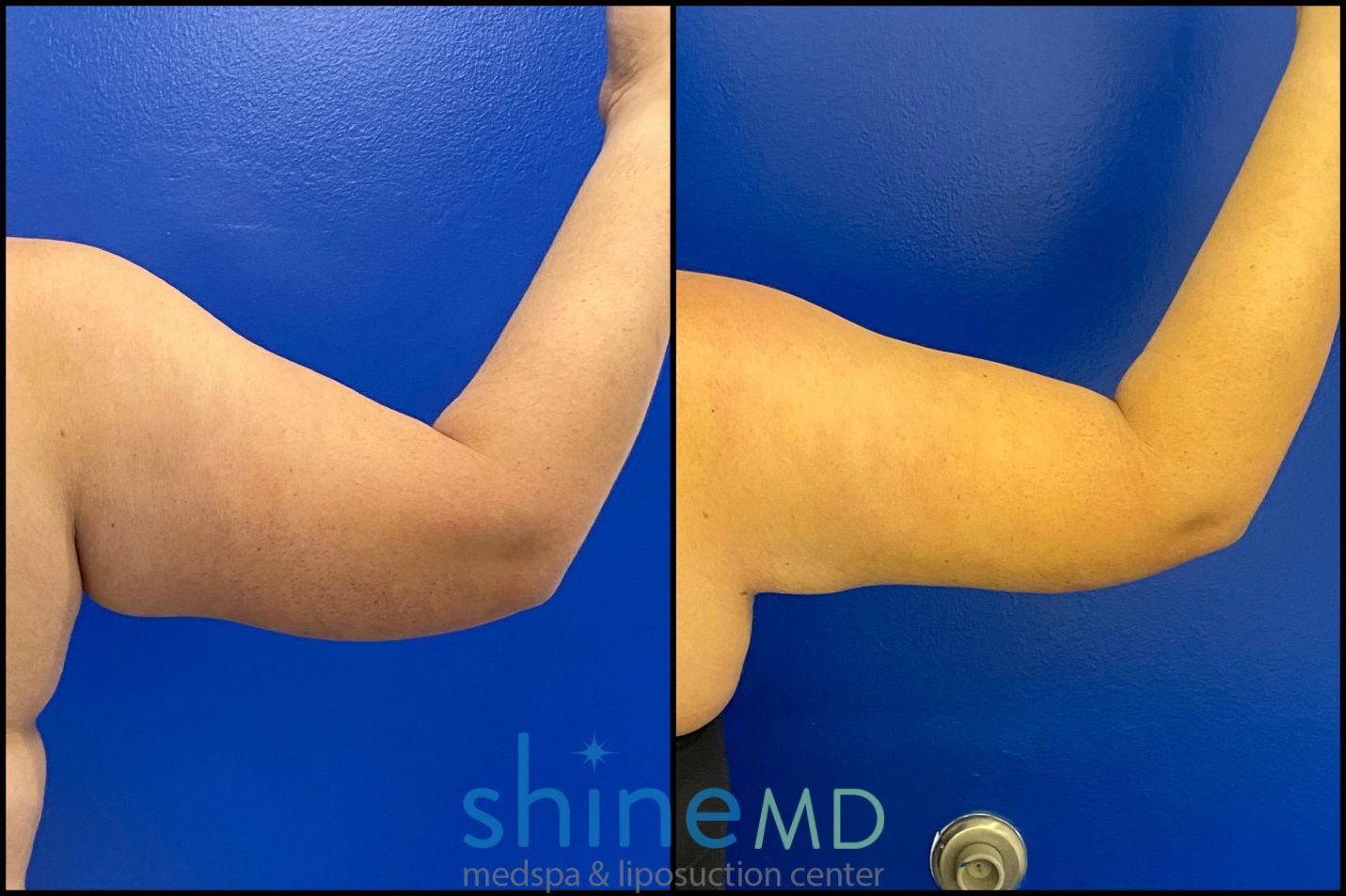 before and after photos of Right-Back-Arm-4
