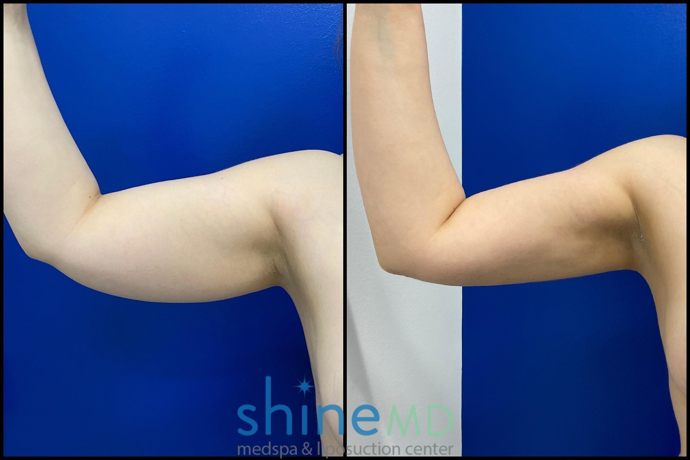 Arm Contouring Surgery before and after photos