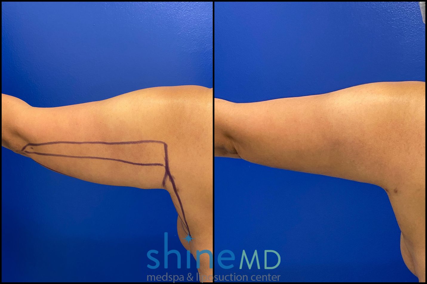 before & after photos of arm liposuction surgery