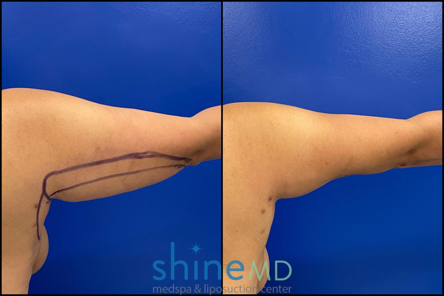 arm liposuction surgery