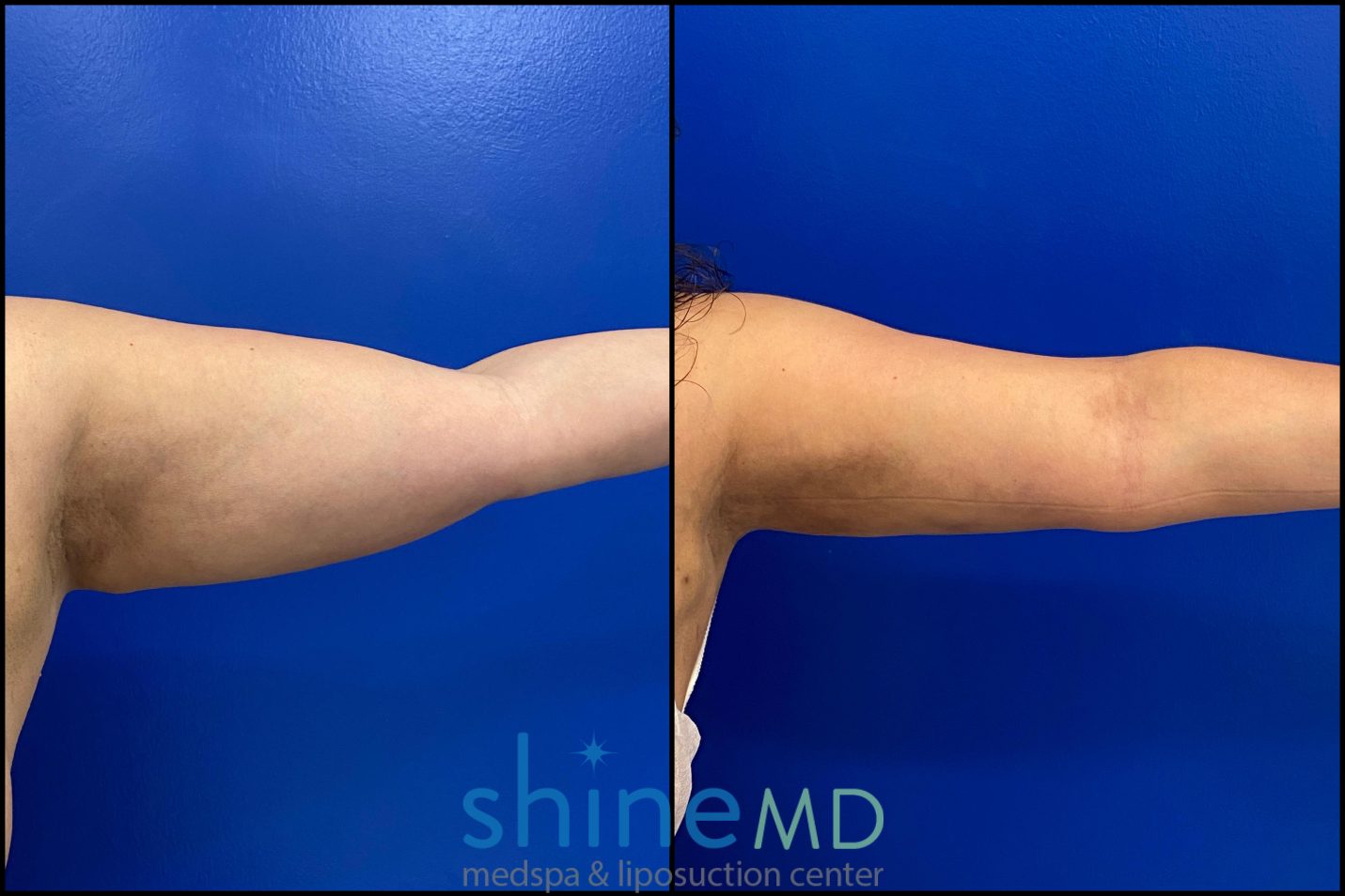 arm liposuction surgery photos
