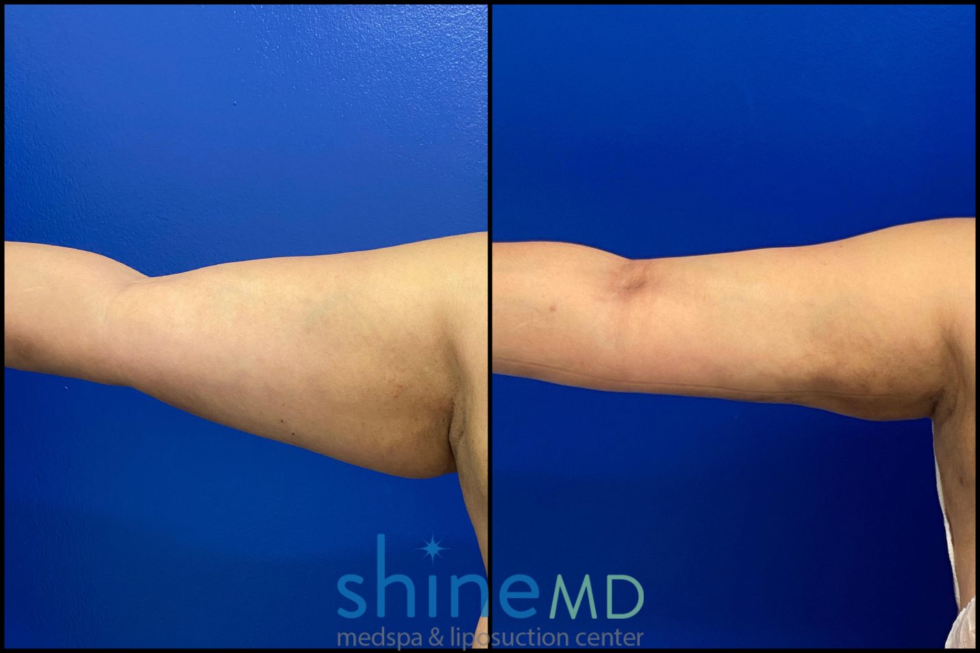 arm liposuction surgery before & after photos
