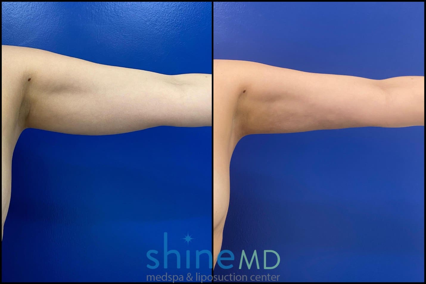 Arm Liposuction Before and After Photos