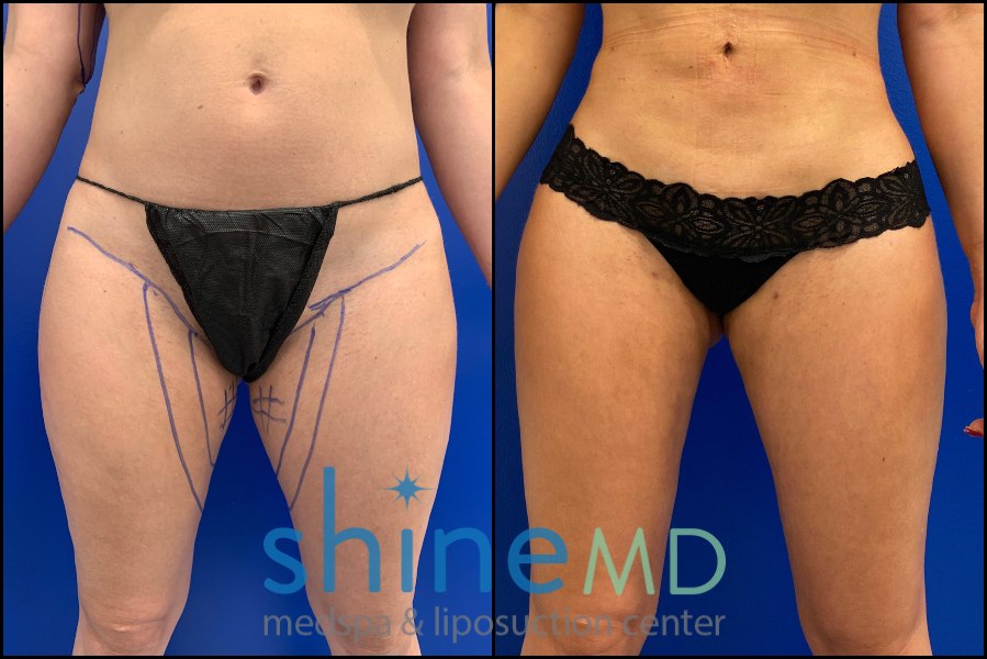 inner thigh lipo before and after results front view 002034