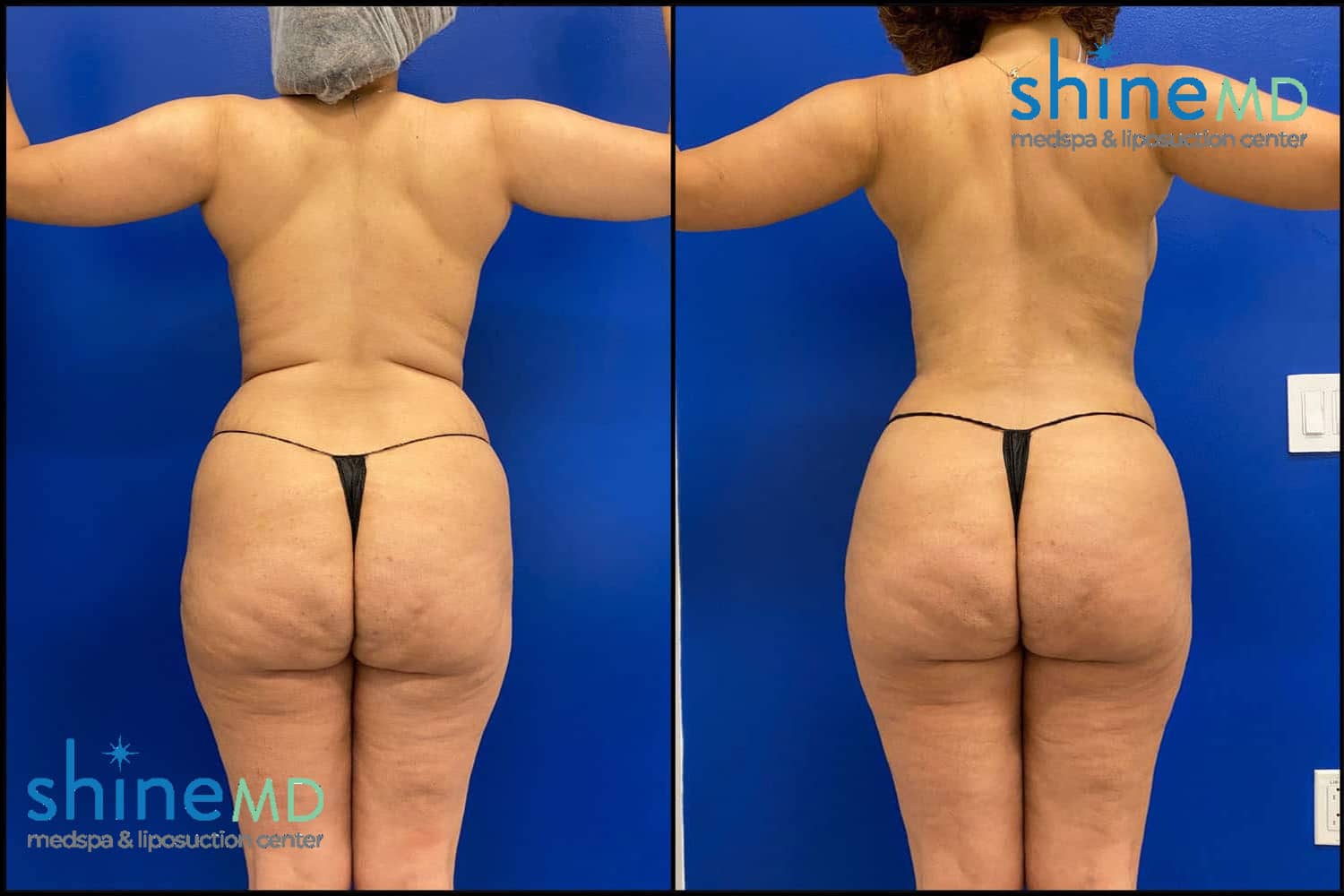 lipo 360 before after picture 4