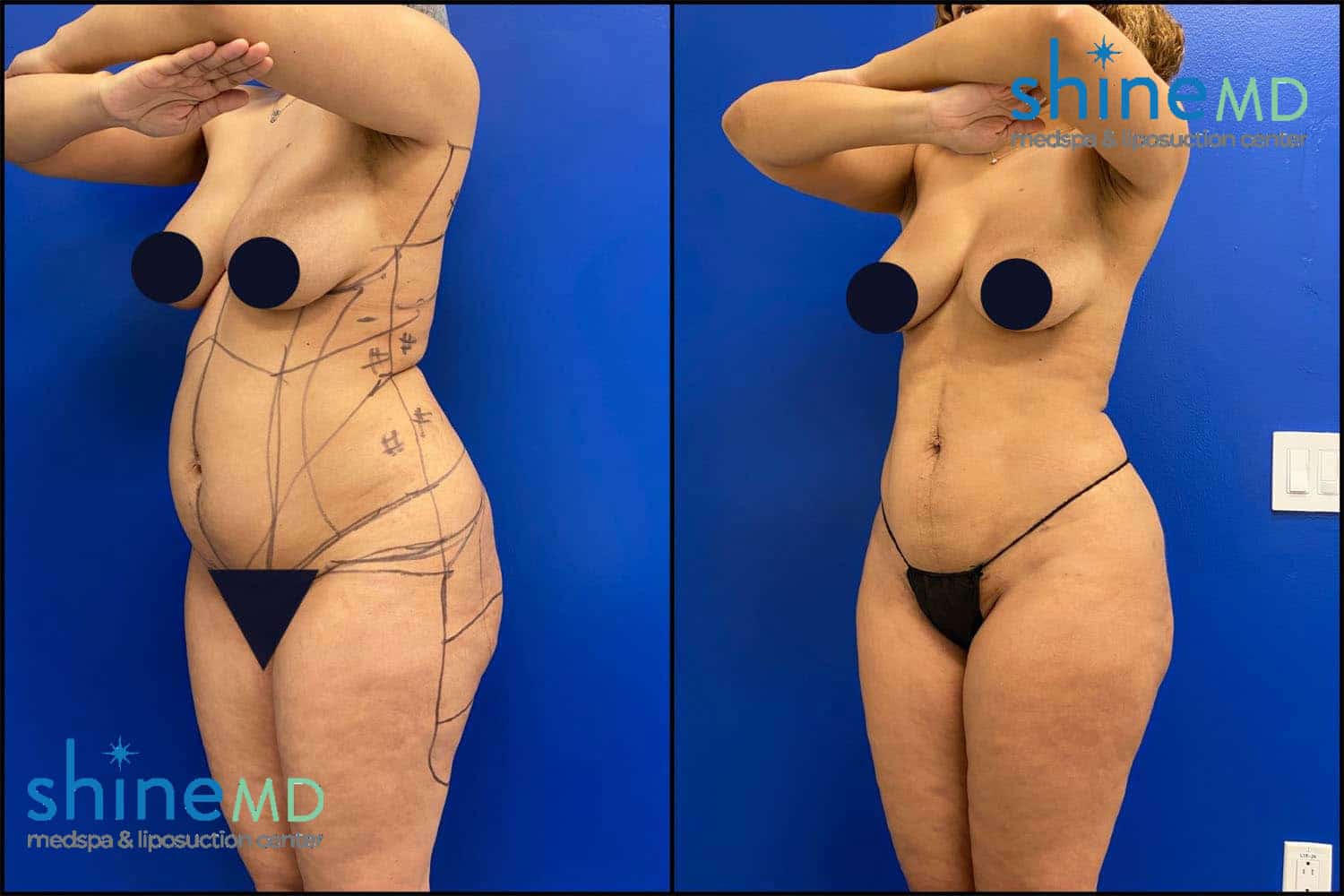 lipo 360 before after picture 2