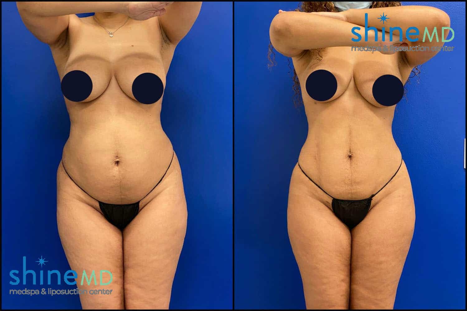 lipo 360 before after picture
