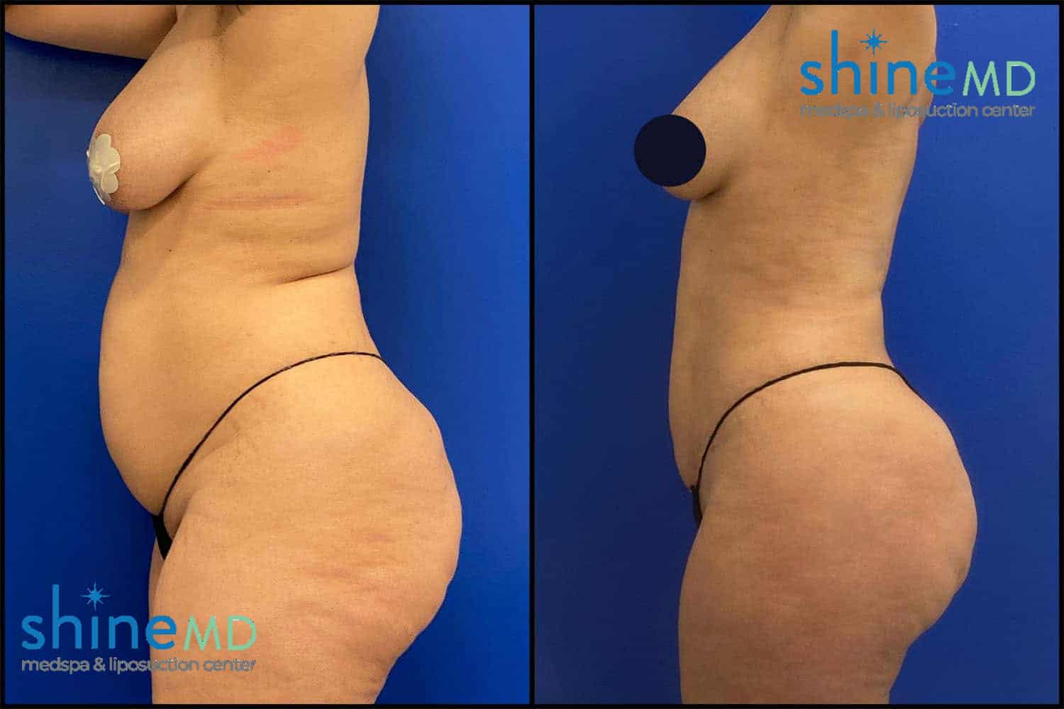 lipo 360 before after picture 3