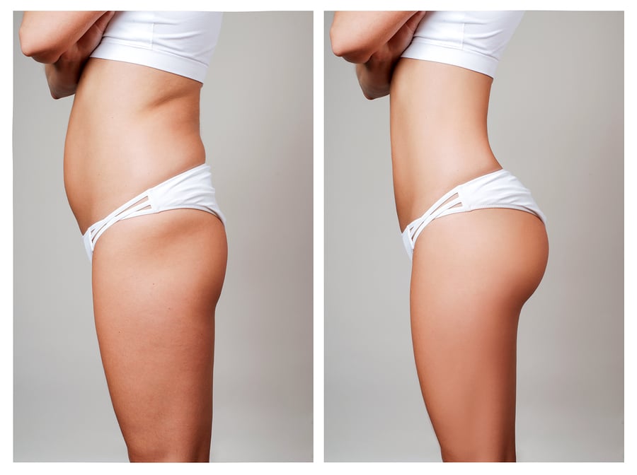 liposuction before and after picture