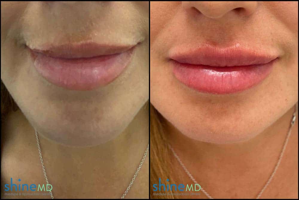 Lip Filler Before & After Pictures