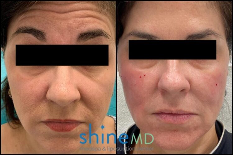 botox forehead before and after shinemd patient 2056