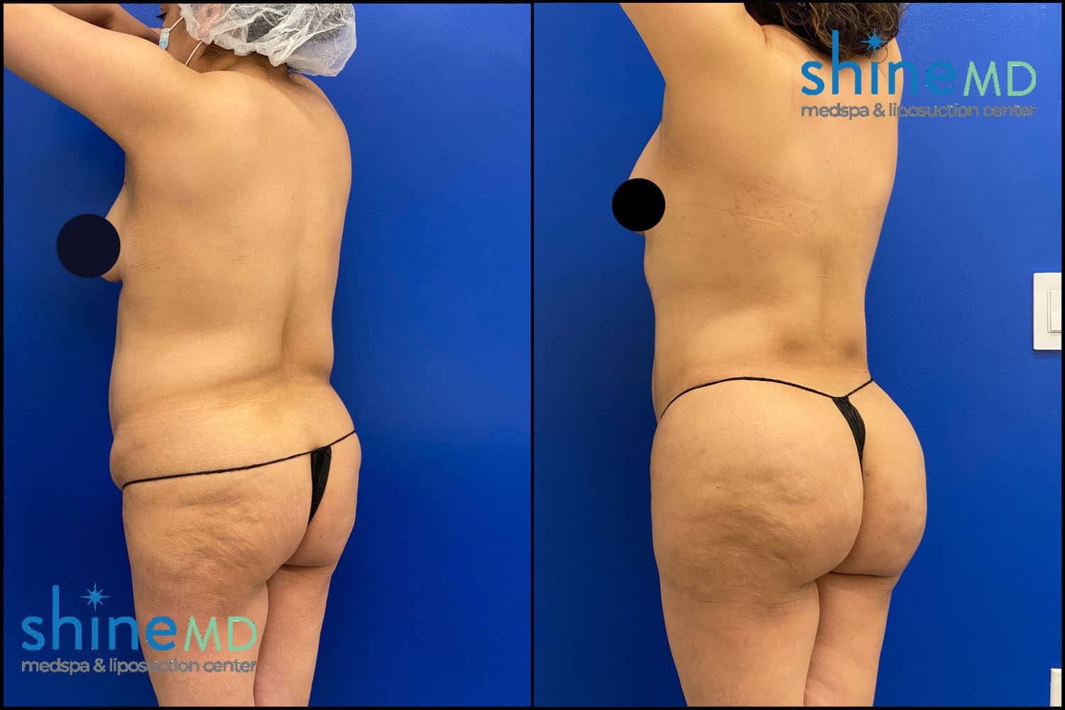 Liposuction 360 with BBL Before And After Photos