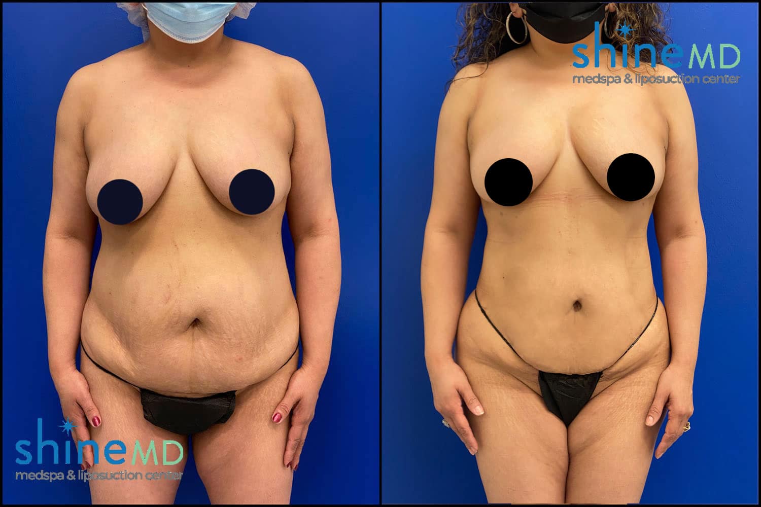 Liposuction 360 with BBL