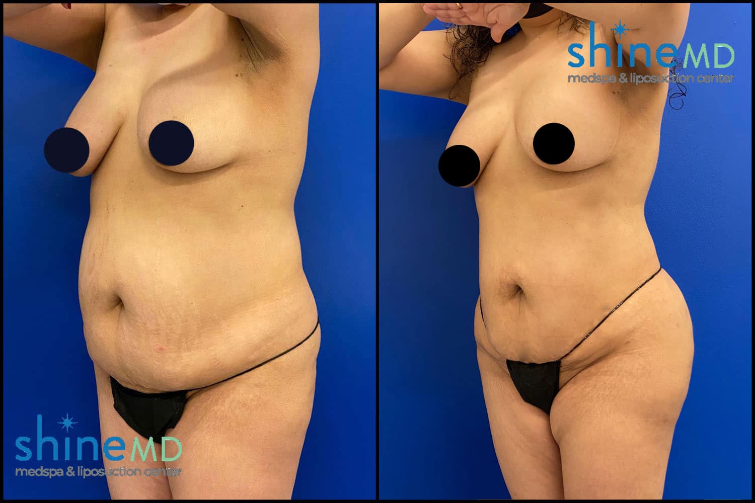 Liposuction 360 with BBL Treatment Photos