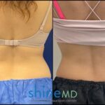 Back View CoolSculpting Results PATIENT-ShineMD-002081