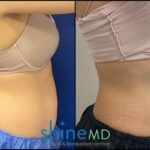 Side View CoolSculpting Results PATIENT-ShineMD-002081