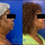 Side view Chin Lipo before and after for patient 2078