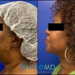 Left side view of Chin Liposuction for PATIENT 002078