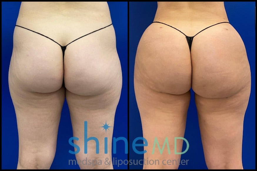 inner thigh lipo before and after results back view 002079