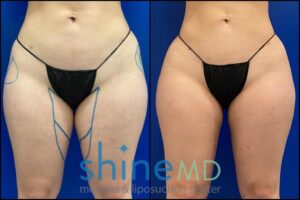 inner thigh lipo before and after results front view 002079