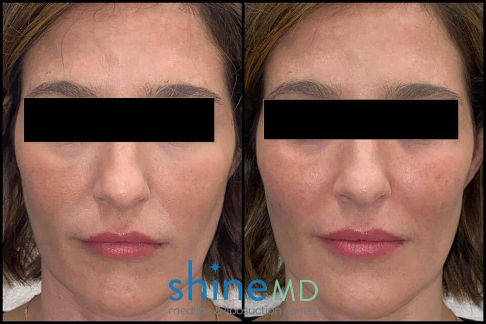 Radiesse for cheek fillers before and after image