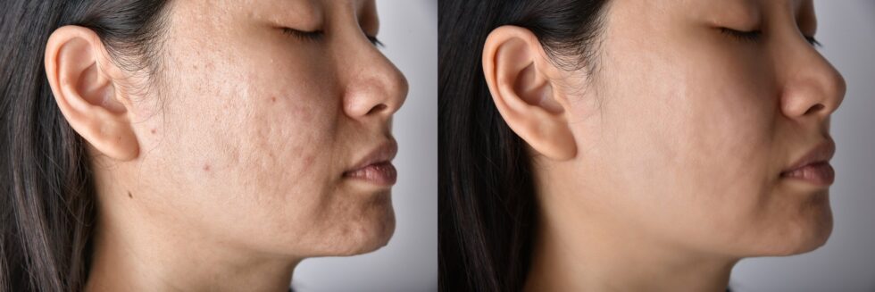 Skin problems and acne scar, Before and after dermal fillers treatment