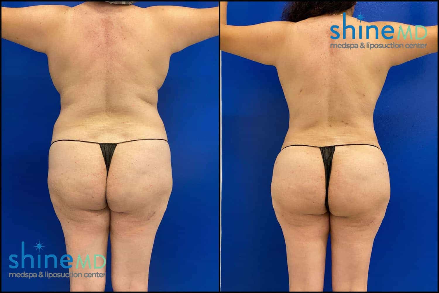 body contouring before & after photos