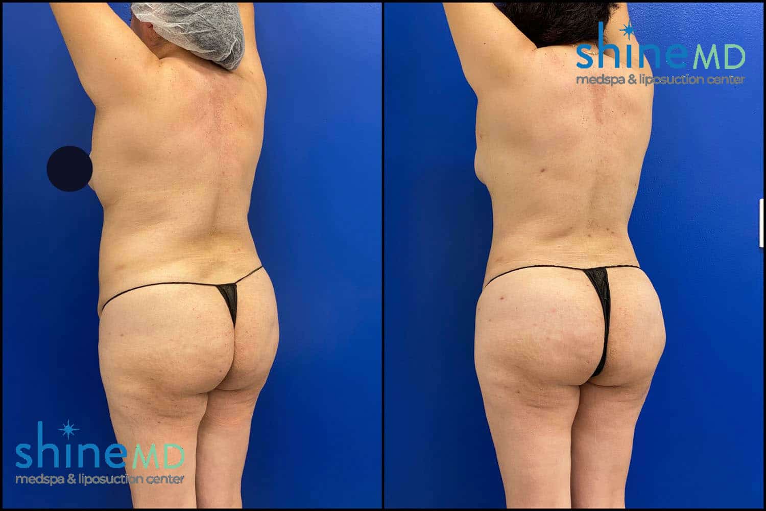 body contouring surgery before & after photos