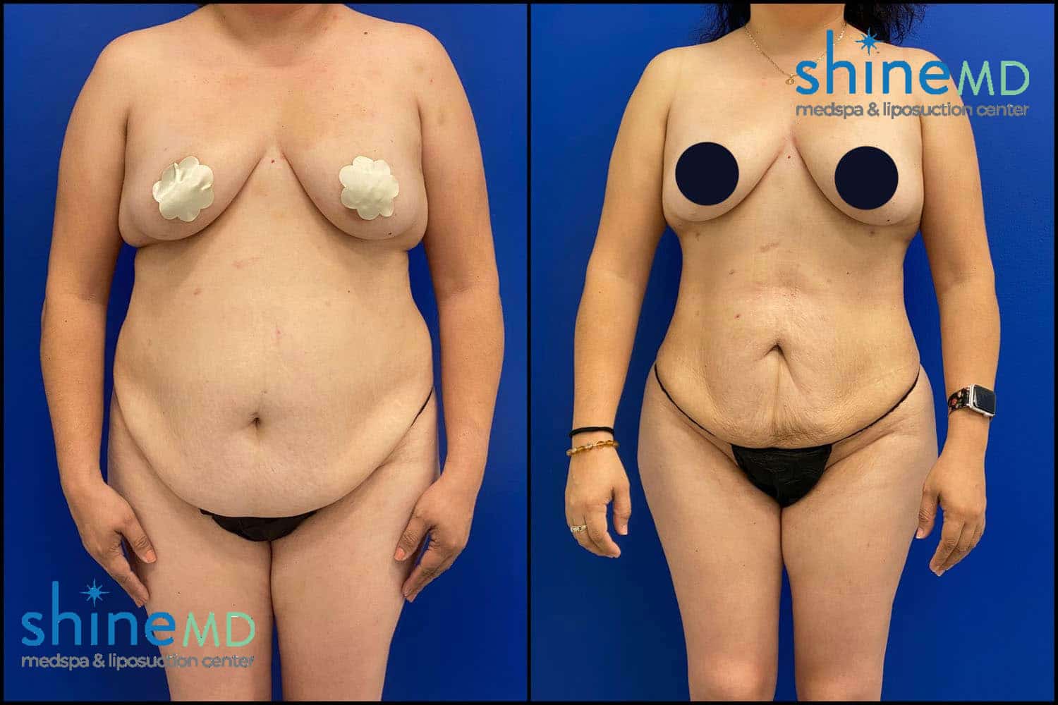 body contouring surgery before & after