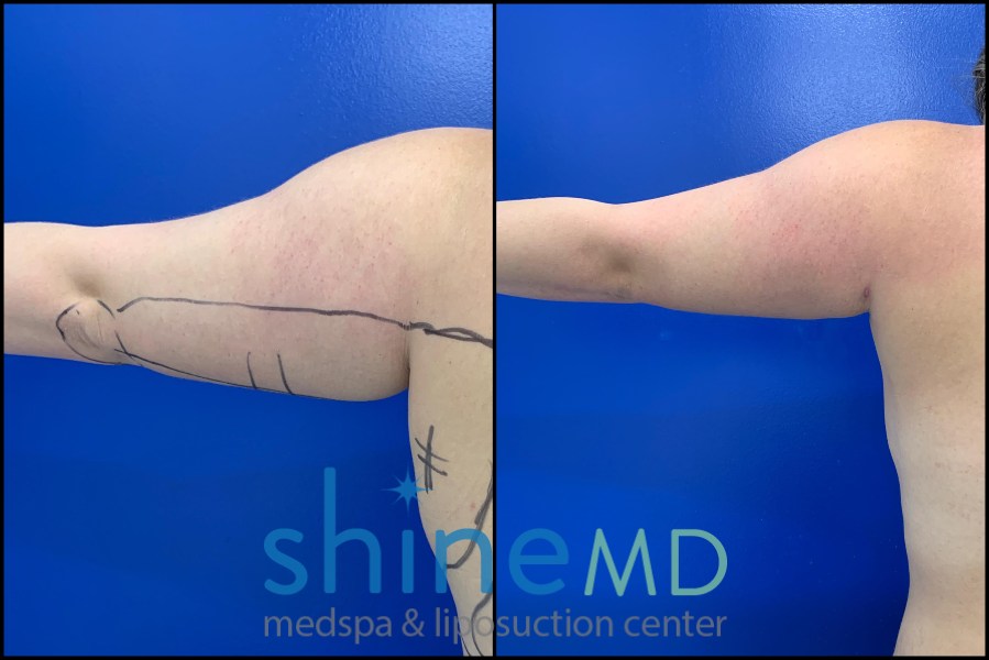 arm liposuction before and left back1622035