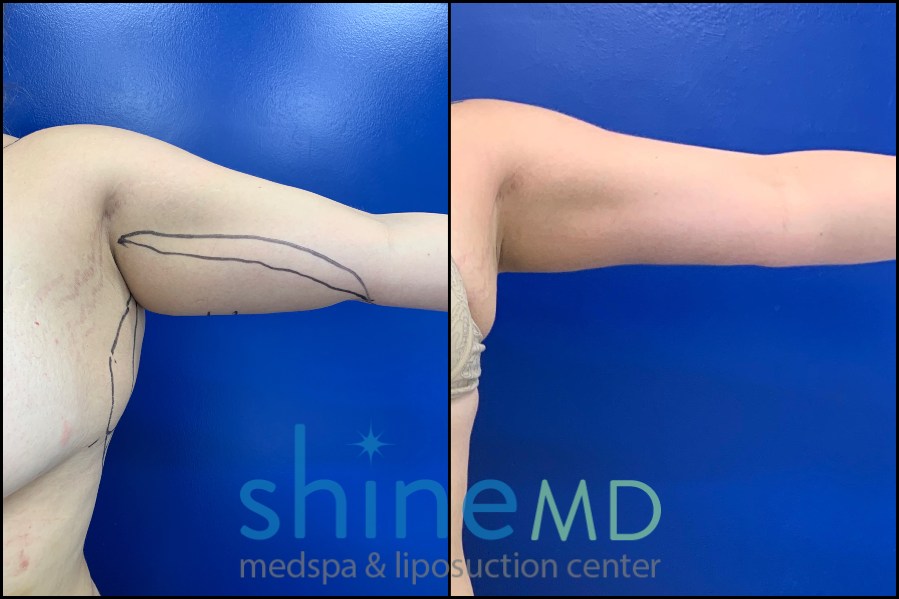 arm liposuction before and after left front 1622035