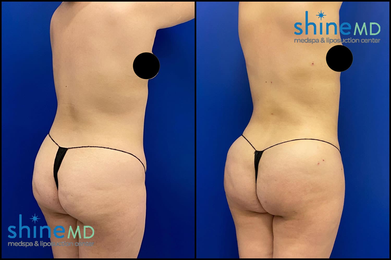 Body Sculpting Liposuction Before & After Photos ShineMD
