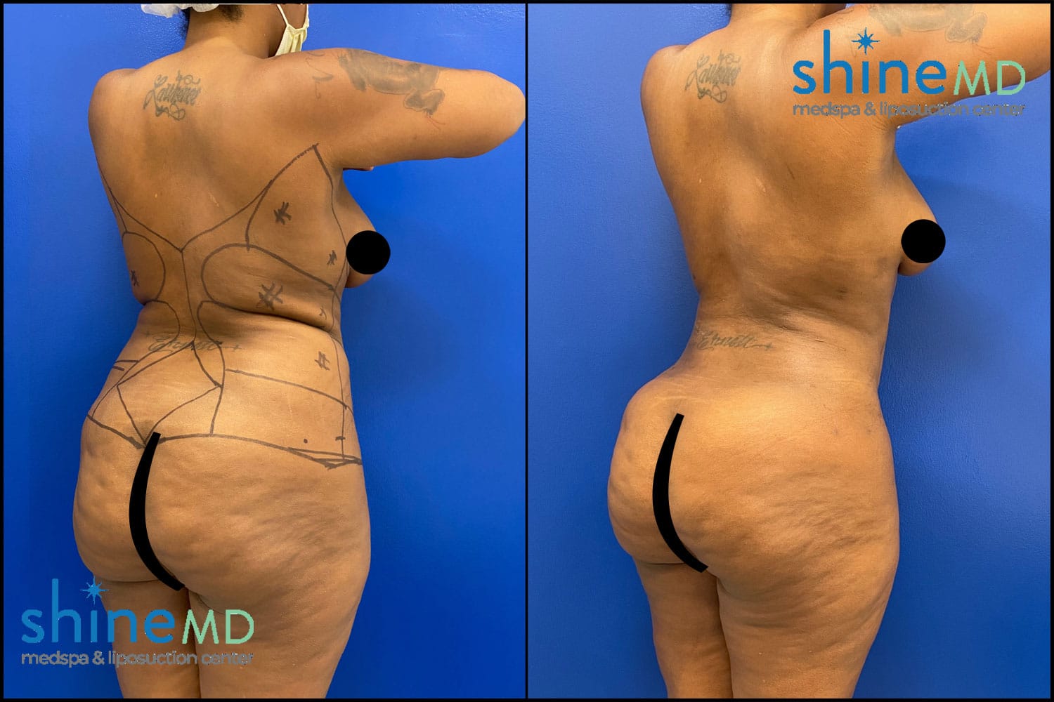 Lipo360 with Chin Lipo Before & After Photos