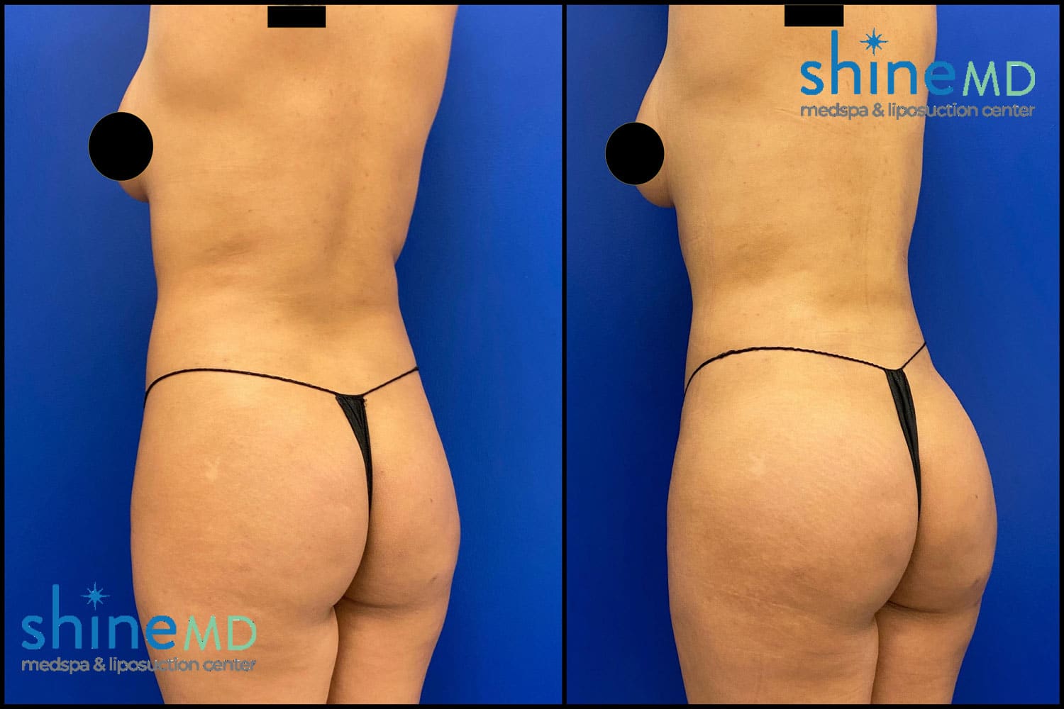 Lipo360 with BBL Before & After Photo of ShineMD