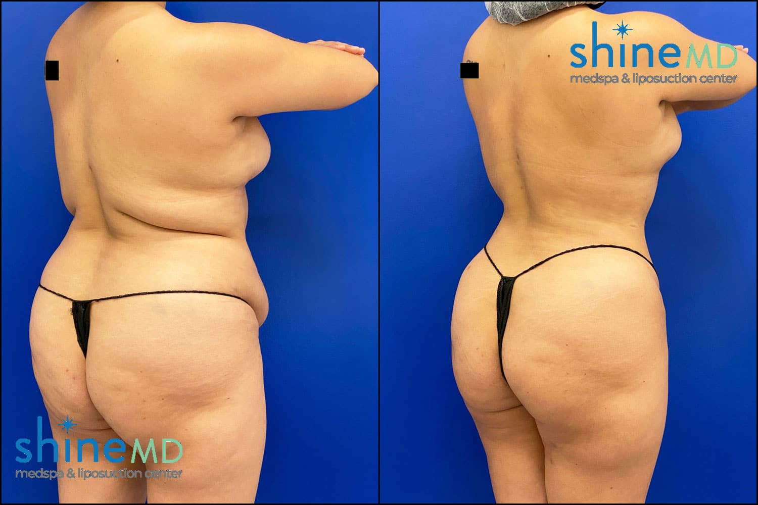 Lipo 360 Before and After Photo ShineMD
