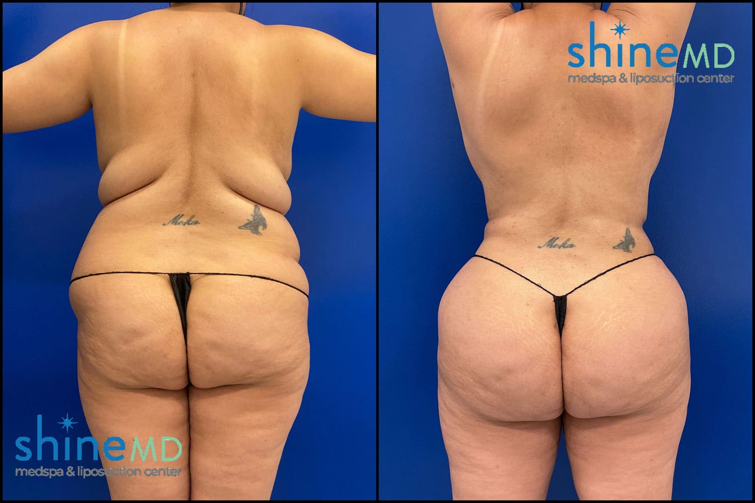 Liposuction Surgery Results before after photos
