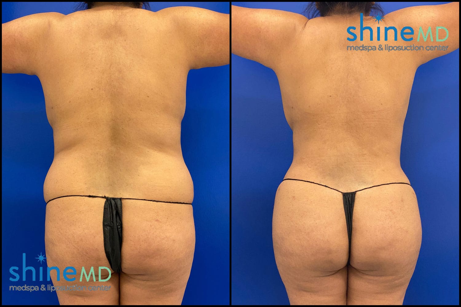 Before & After Photo of Lipo 360 ShineMD