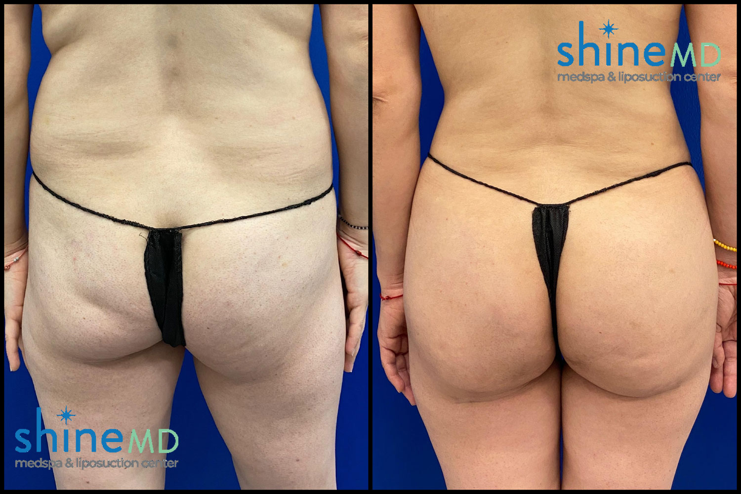 lipo360 before & after photo 2