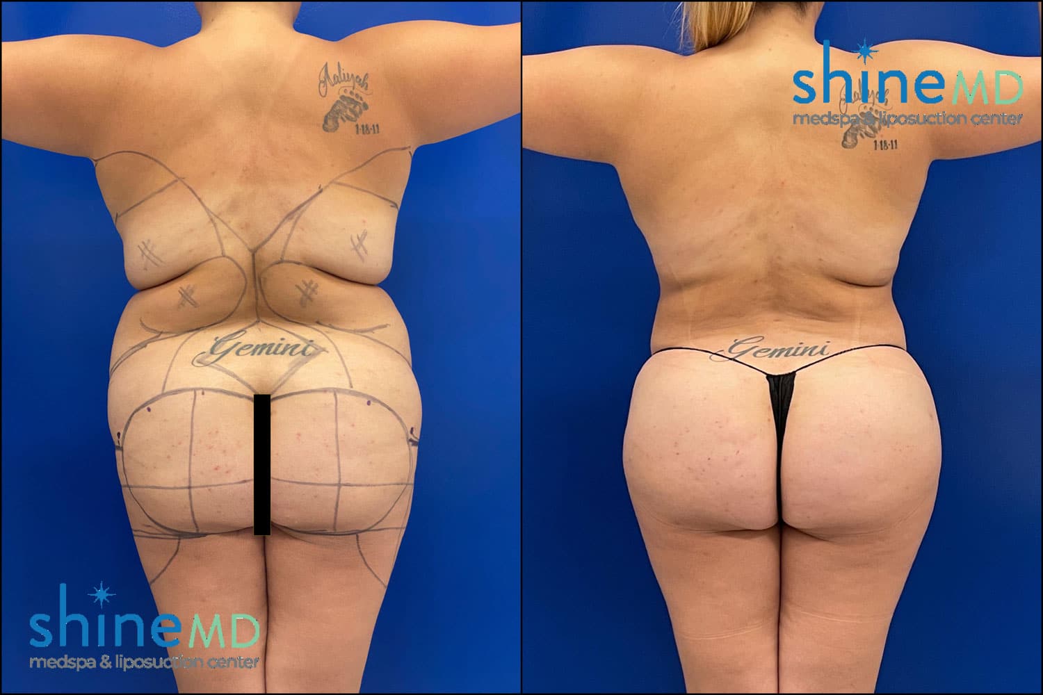 Lipo & Before & After Photo