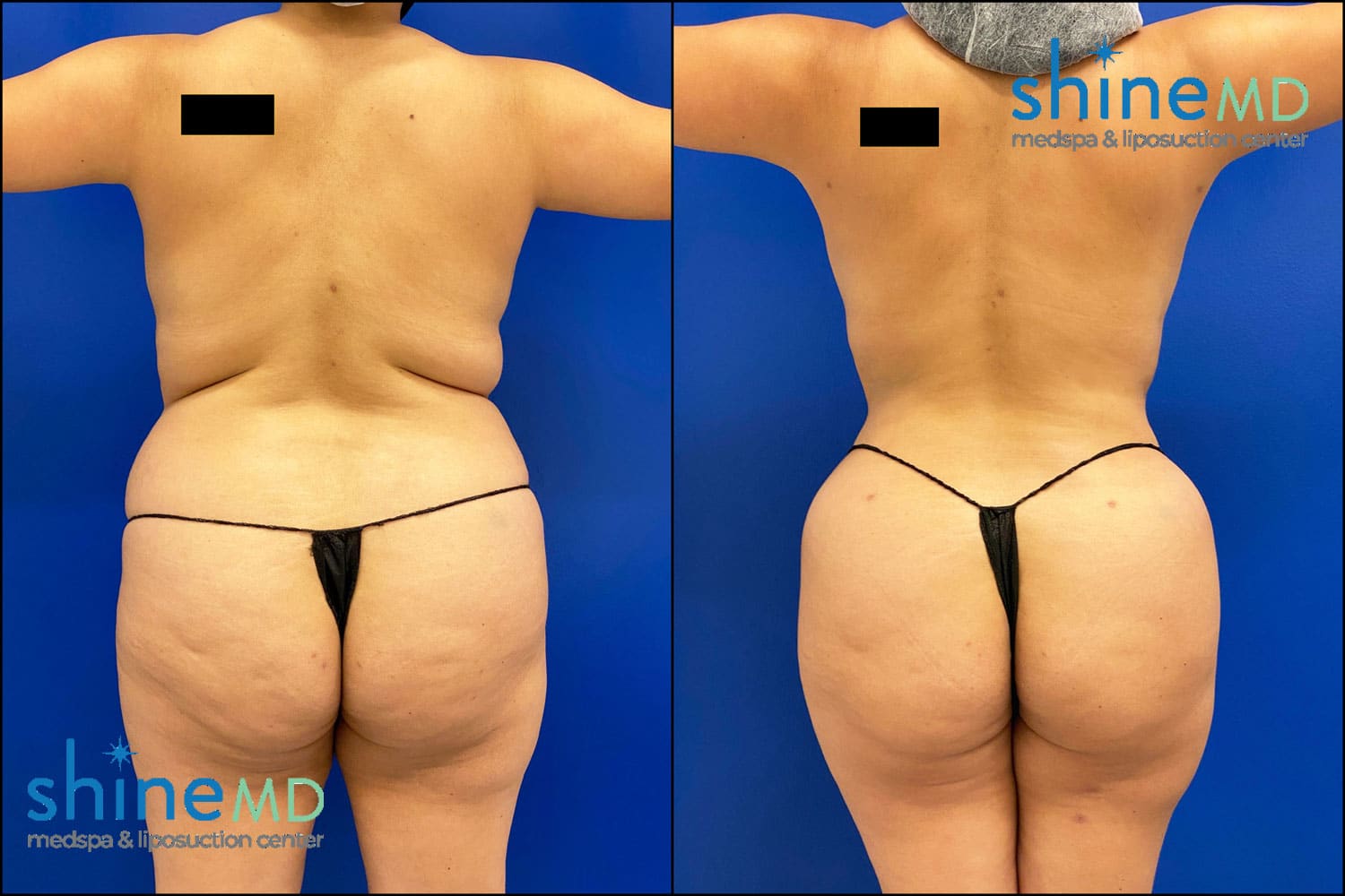 Lipo 360 Before and After Photo