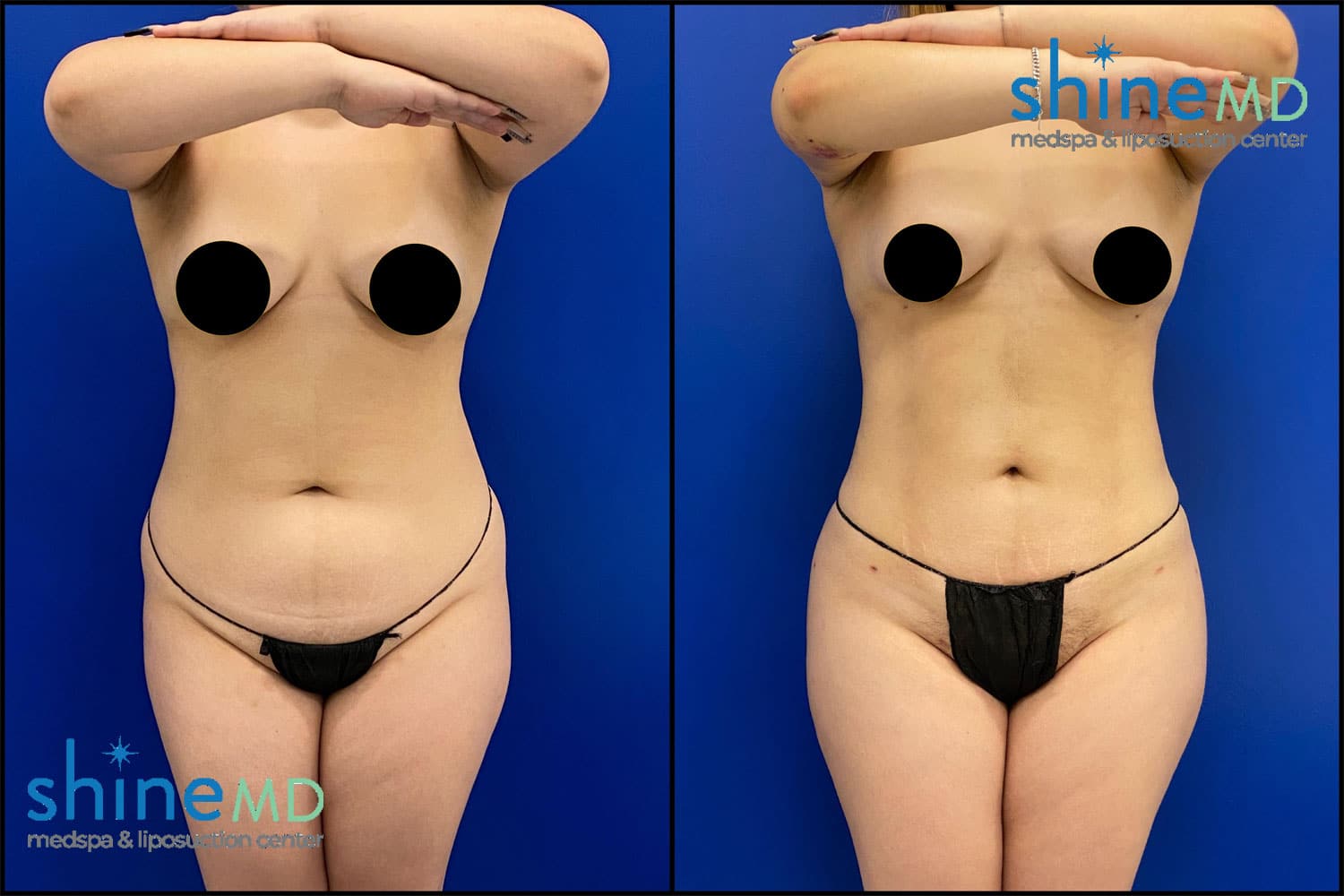 Body Sculpting Liposuction Before & After Photos