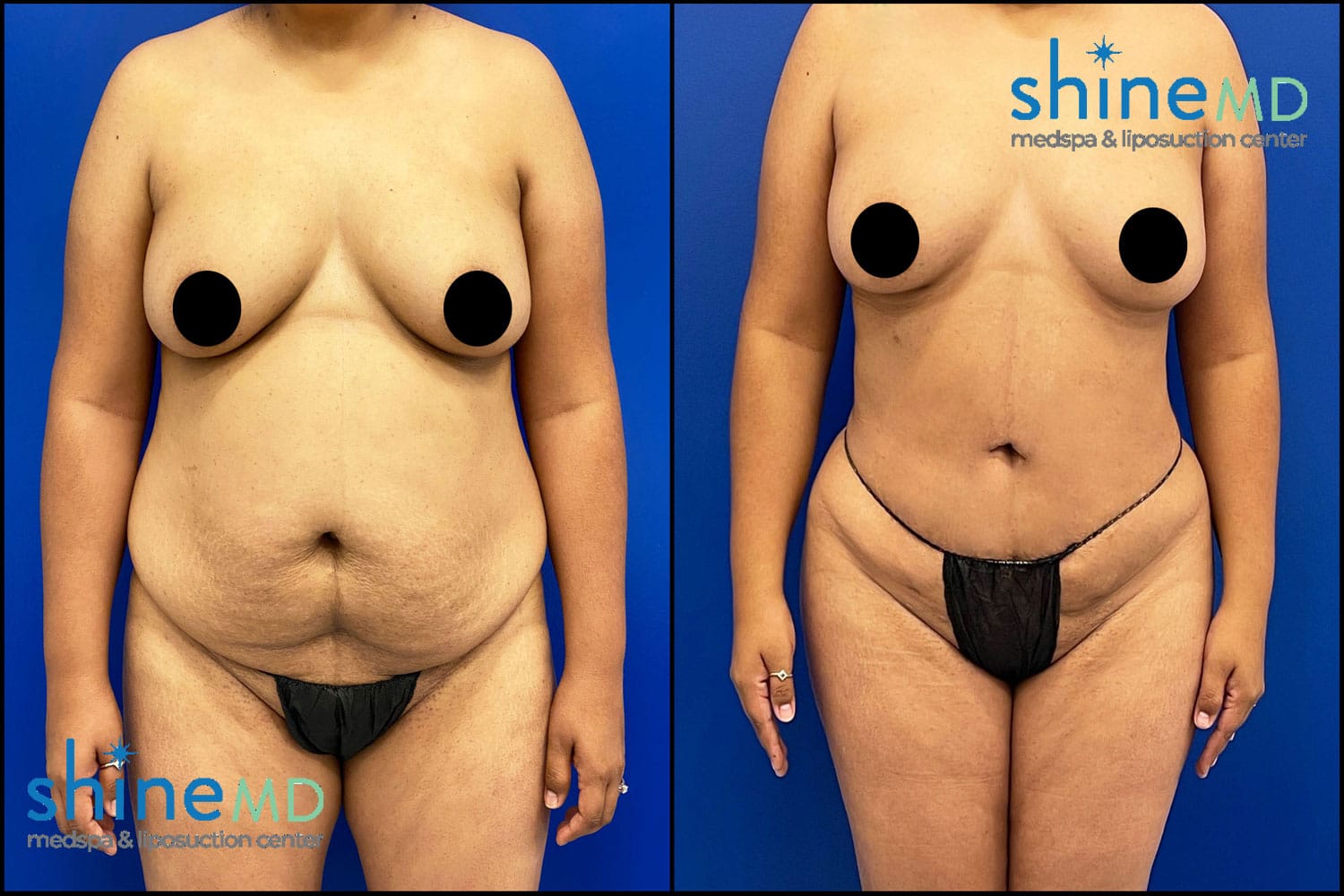 Before & After Photo of Lipo 360