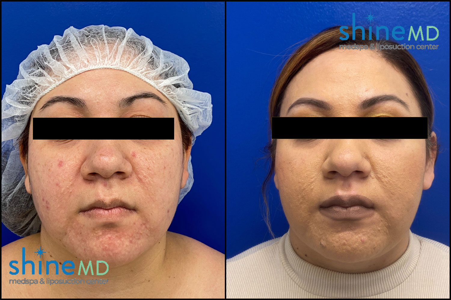Chin lipo Before & After Photo