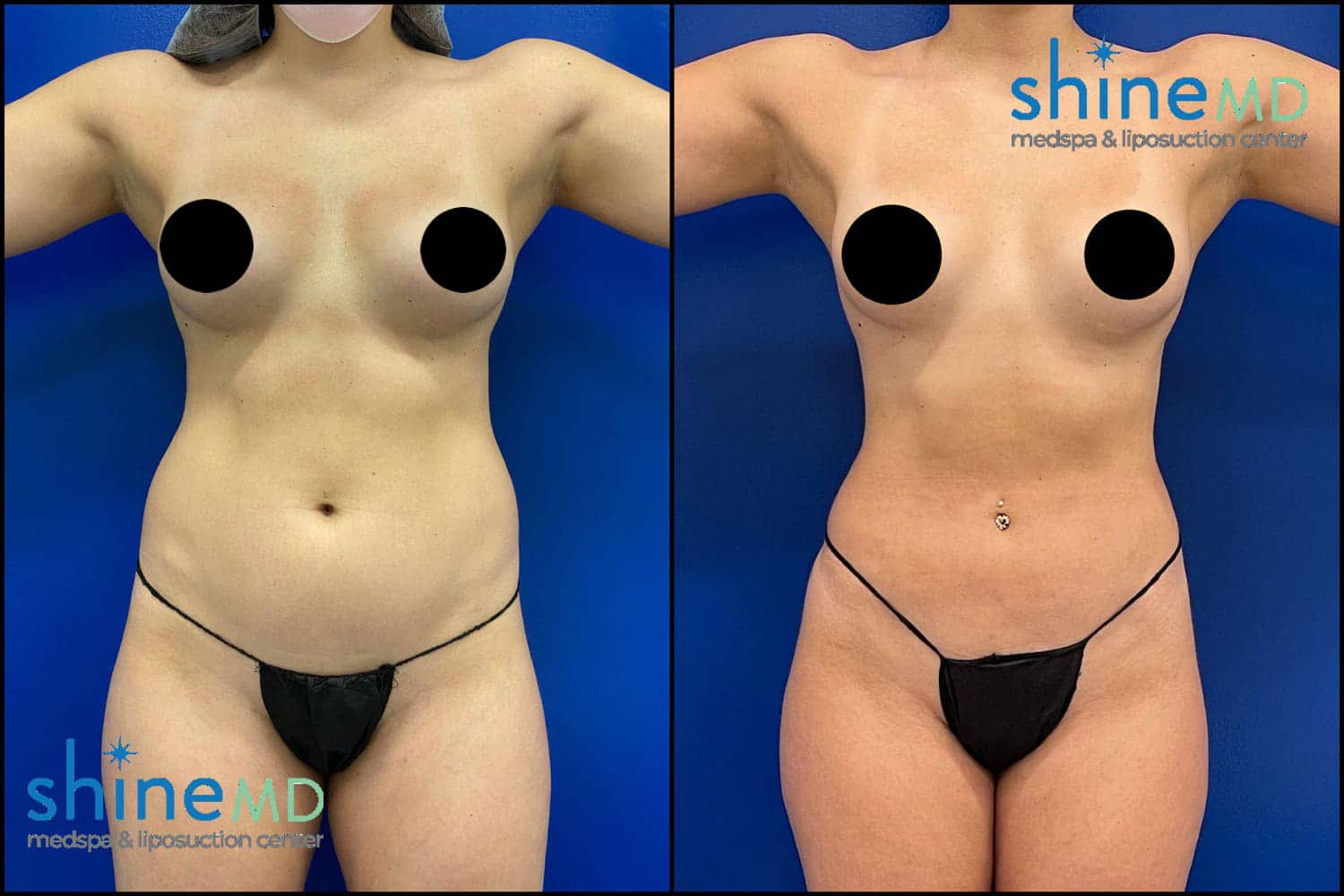 lipo360 before and before picture