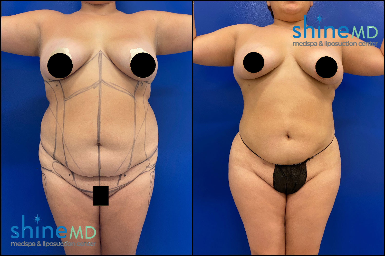 Lipo & BBL Before & After Photo