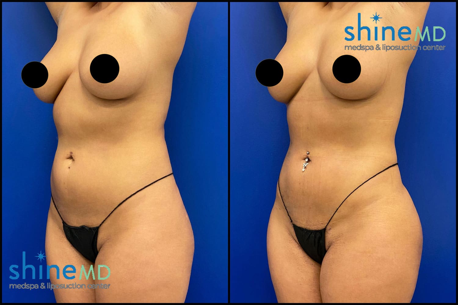 Lipo360 with BBL Photo of ShineMD