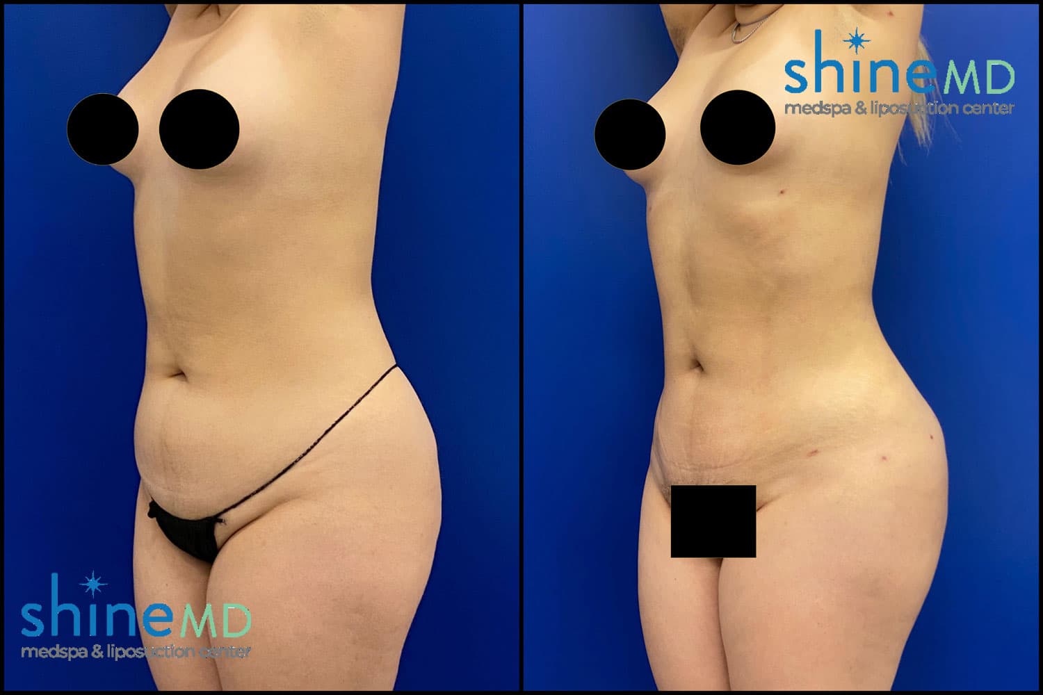 Body Sculpting Liposuction Before & After Photos ShineMD Medspa